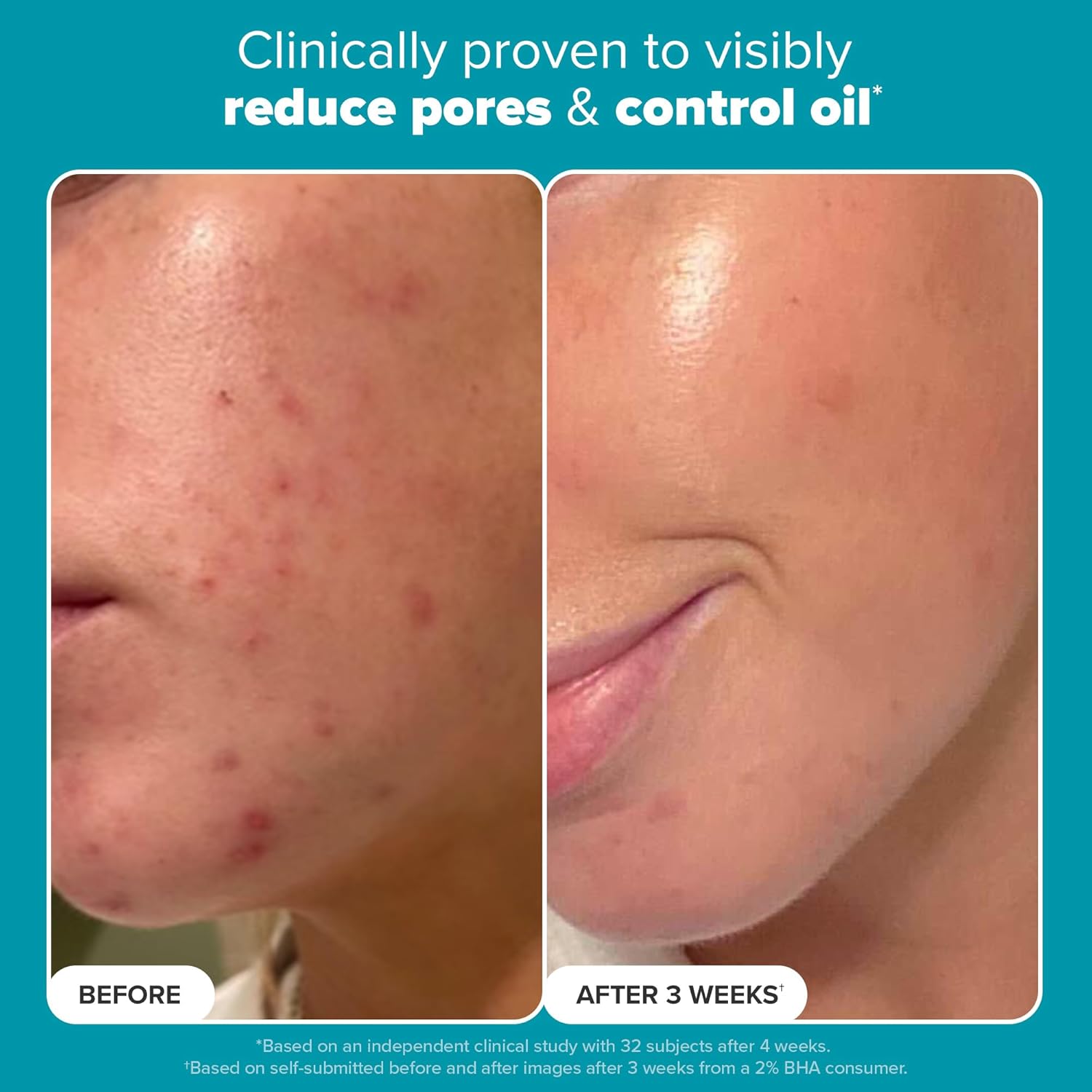 Skin Perfecting 2% BHA Liquid Salicylic Acid Exfoliant, Gentle Facial Exfoliator for Blackheads, Large Pores, Wrinkles & Fine Lines, Travel Size, 30 Ml Bottle